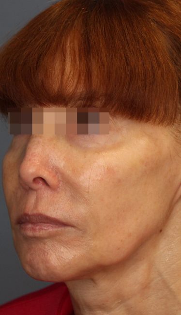 Fillers Before and After - Case 44, Image 6 - Female, age 35 – 44 - Baltimore, MD - Skin Therapeutics Med Spa