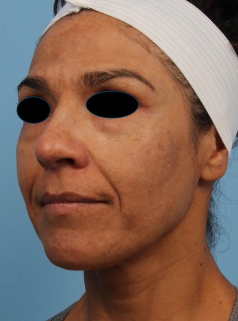 Spectra Before and After - Case 4, Image 2 - Female, age 35 – 44 - Baltimore, MD - Skin Therapeutics Med Spa