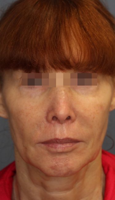 Fillers Before and After - Case 44, Image 8 - Female, age 35 – 44 - Baltimore, MD - Skin Therapeutics Med Spa