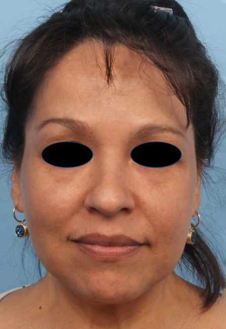 Spectra Before and After - Case 5, Image 2 - Female, age 35 – 44 - Baltimore, MD - Skin Therapeutics Med Spa