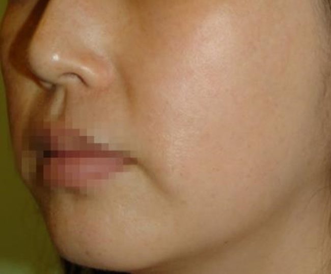 Spectra Before and After - Case 6, Image 2 - Female, age 25 – 34 - Baltimore, MD - Skin Therapeutics Med Spa