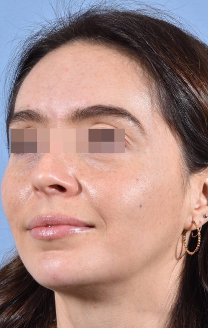 Fillers Before and After - Case 34, Image 2 - Female, age 25 – 34 - Baltimore, MD - Skin Therapeutics Med Spa