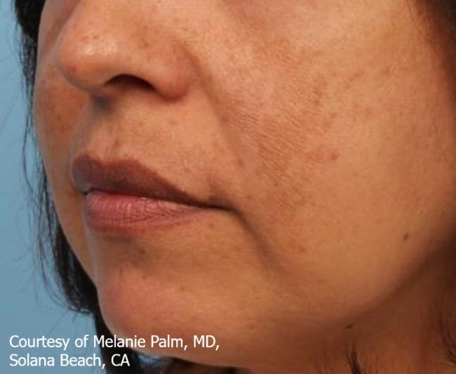 Spectra Before and After - Case 2, Image 1 - Female, age 35 – 44 - Baltimore, MD - Skin Therapeutics Med Spa