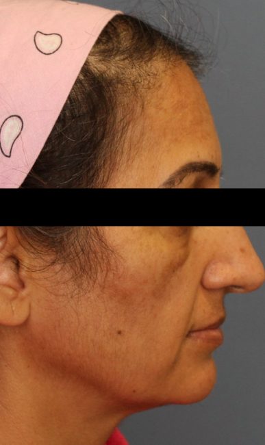 Fillers Before and After - Case 35, Image 1 - Female, age 45 – 54 - Baltimore, MD - Skin Therapeutics Med Spa