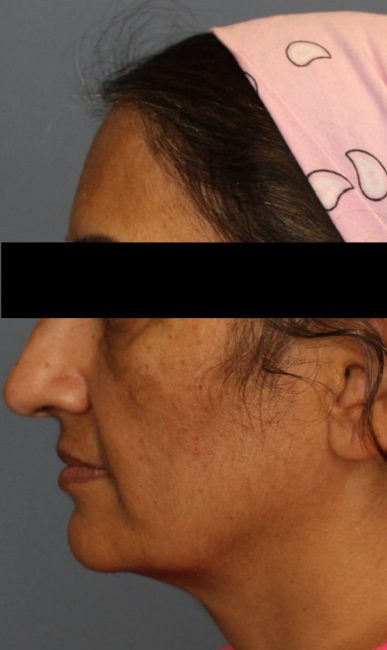 Fillers Before and After - Case 35, Image 3 - Female, age 45 – 54 - Baltimore, MD - Skin Therapeutics Med Spa