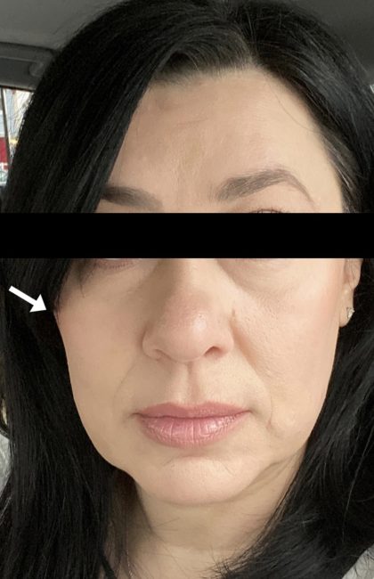 Fillers Before and After - Case 36, Image 1 - Female, age 35 – 44 - Baltimore, MD - Skin Therapeutics Med Spa