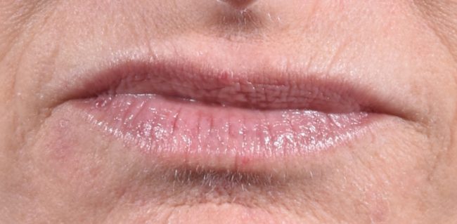 Fillers Before and After - Case 38, Image 1 - Female, age 35 – 44 - Baltimore, MD - Skin Therapeutics Med Spa