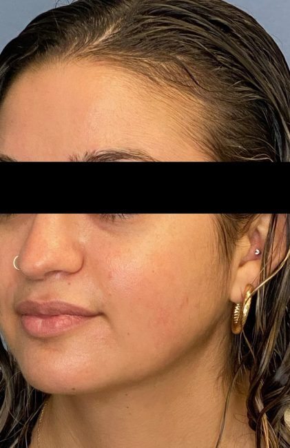 Fillers Before and After - Case 41, Image 1 - Female, age 18 – 24 - Baltimore, MD - Skin Therapeutics Med Spa