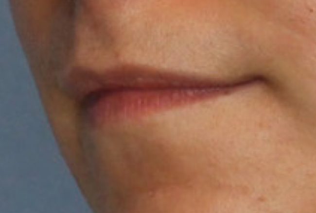 Fillers Before and After - Case 39, Image 3 - Female, age 18 – 24 - Baltimore, MD - Skin Therapeutics Med Spa