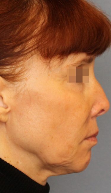 Fillers Before and After - Case 44, Image 3 - Female, age 35 – 44 - Baltimore, MD - Skin Therapeutics Med Spa