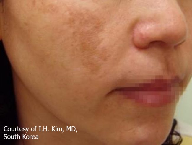 Spectra Before and After - Case 3, Image 1 - Female, age 25 – 34 - Baltimore, MD - Skin Therapeutics Med Spa