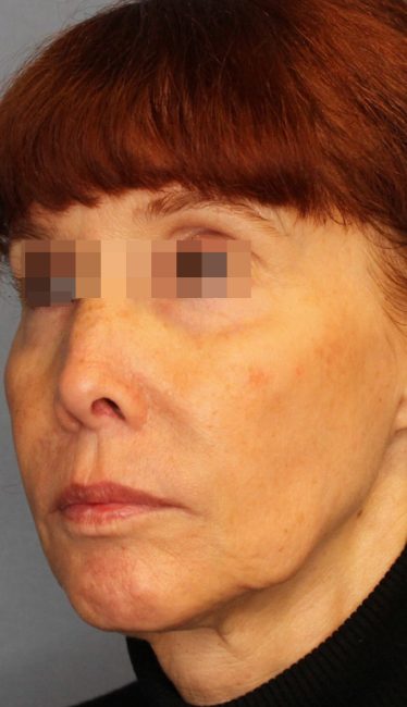 Fillers Before and After - Case 44, Image 5 - Female, age 35 – 44 - Baltimore, MD - Skin Therapeutics Med Spa