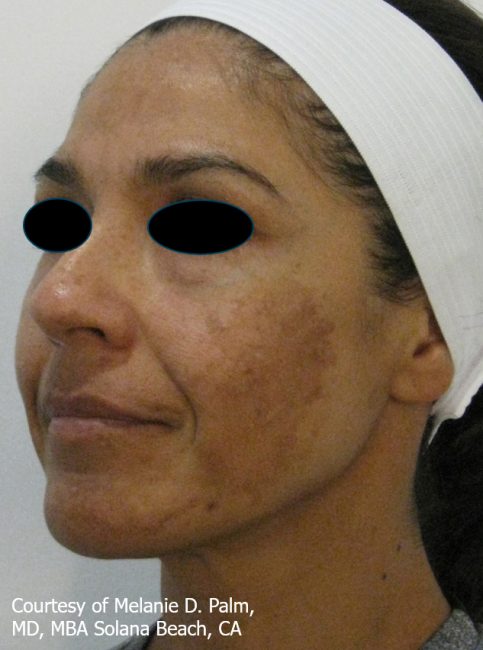 Spectra Before and After - Case 4, Image 1 - Female, age 35 – 44 - Baltimore, MD - Skin Therapeutics Med Spa