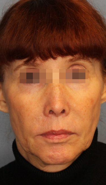 Fillers Before and After - Case 44, Image 7 - Female, age 35 – 44 - Baltimore, MD - Skin Therapeutics Med Spa