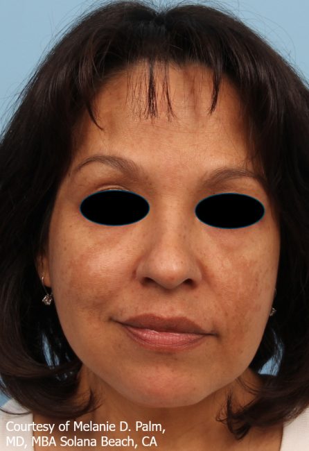 Spectra Before and After - Case 5, Image 1 - Female, age 35 – 44 - Baltimore, MD - Skin Therapeutics Med Spa