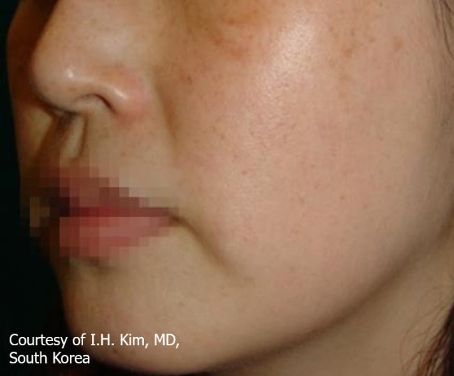 Spectra Before and After - Case 6, Image 1 - Female, age 25 – 34 - Baltimore, MD - Skin Therapeutics Med Spa