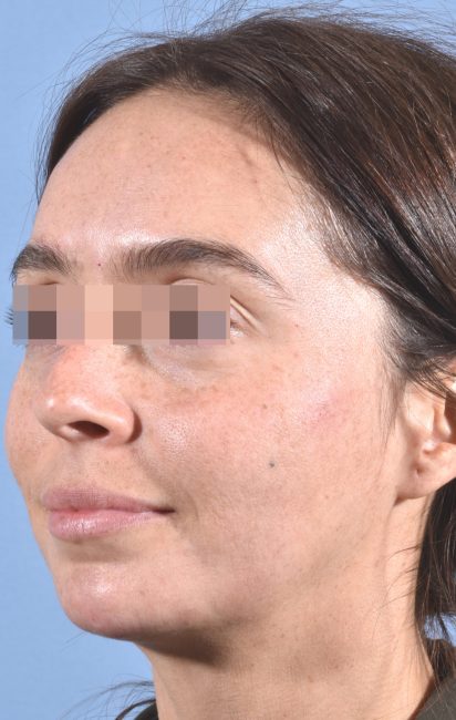 Fillers Before and After - Case 34, Image 1 - Female, age 25 – 34 - Baltimore, MD - Skin Therapeutics Med Spa